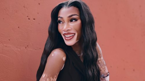  Beyond the skin: Winnie Harlow on vitiligo, visibility, and the power of choice