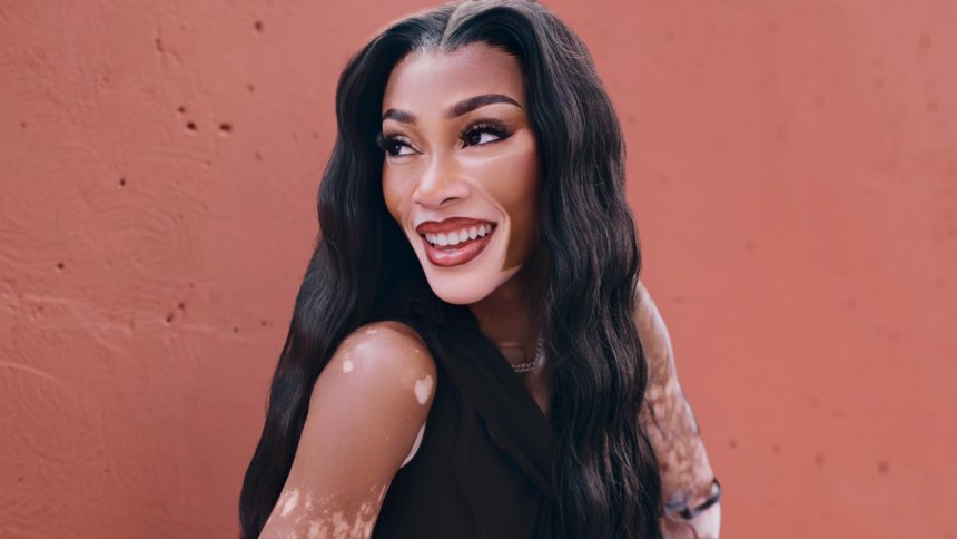  Beyond the skin: Winnie Harlow on vitiligo, visibility, and the power of choice