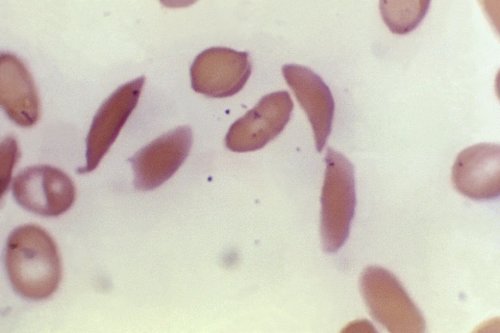 ‘Life two’: Louisiana man becomes first in state to be functionally cured of sickle cell disease