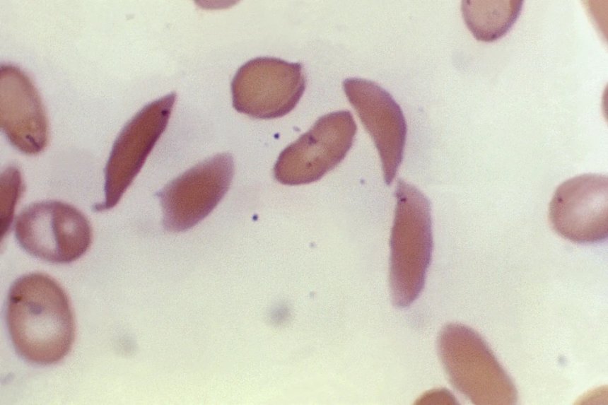 ‘Life two’: Louisiana man becomes first in state to be functionally cured of sickle cell disease